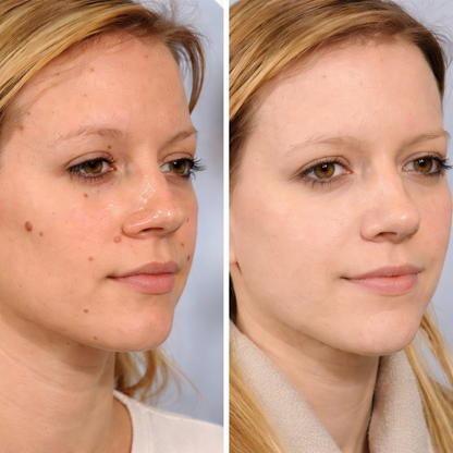 ¡Elimina Verrugas Rápido y Sin Dolor! | Lápiz Removedor Profesional