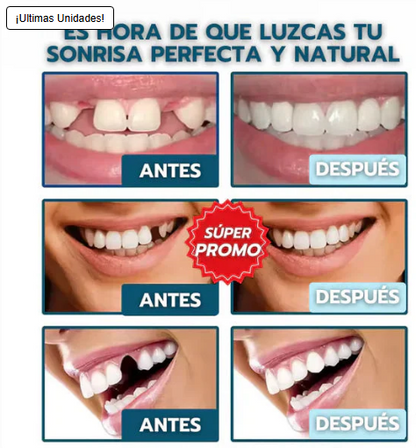 Carillas Dentales