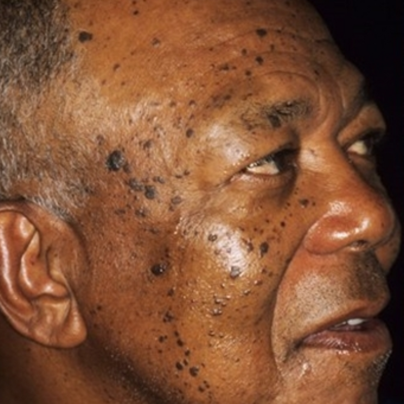 ¡Elimina Verrugas Rápido y Sin Dolor! | Lápiz Removedor Profesional