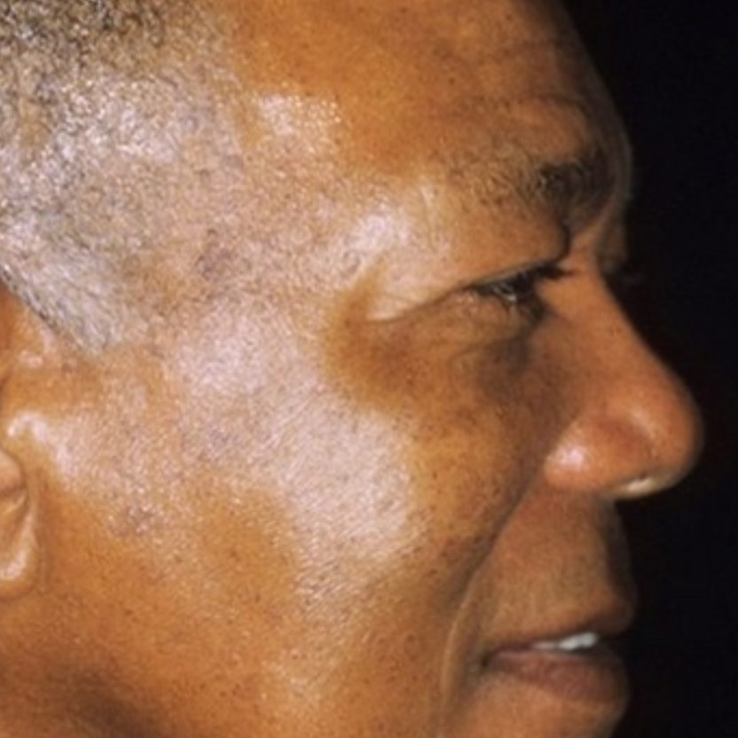 ¡Elimina Verrugas Rápido y Sin Dolor! | Lápiz Removedor Profesional