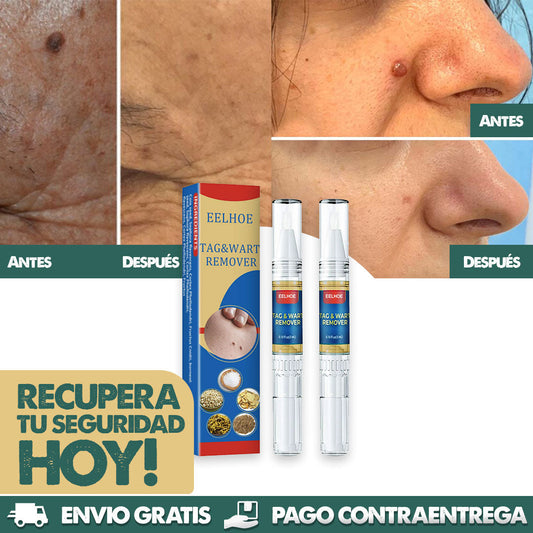 ¡Elimina Verrugas Rápido y Sin Dolor! | Lápiz Removedor Profesional